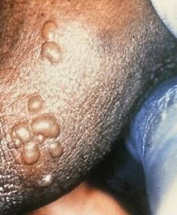 Herpes genitalis Herpes genitalis