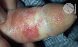 Herpes genitalis Herpes genitalis