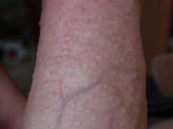 Hirsuties pappillaris penis Hirsuties pappillaris penis