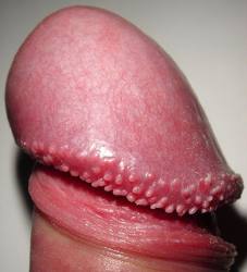 Hirsuties pappillaris penis