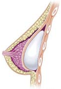 Umístění implantátu pod sval Umístění implantátu pod sval