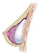Umístění implantátu pod žlázu Umístění implantátu pod žlázu